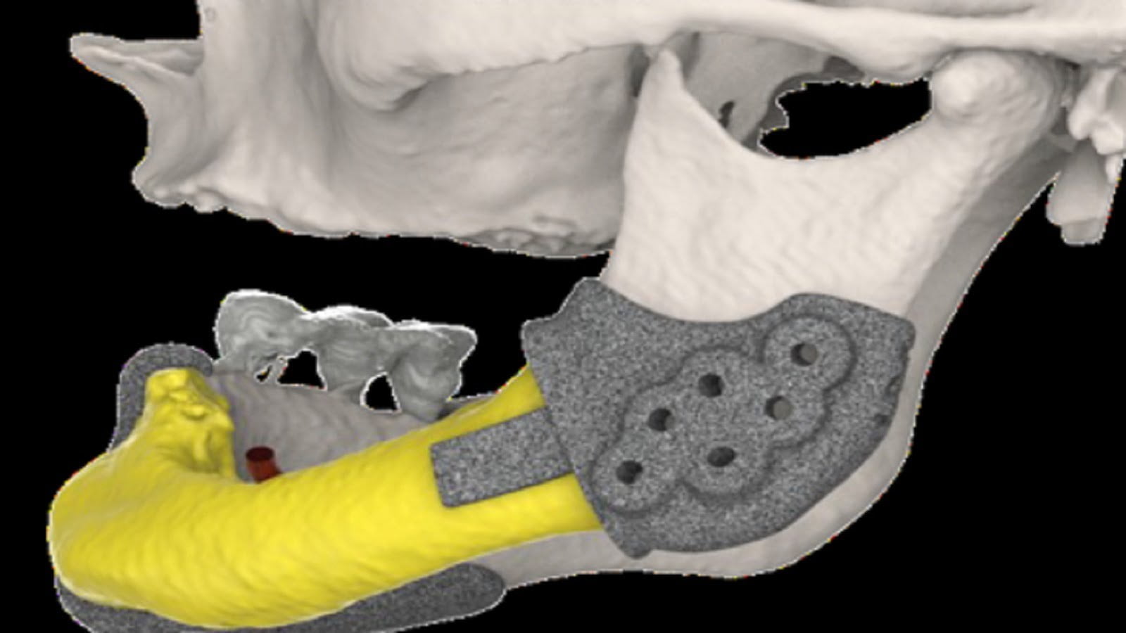 L'équipe di Chirurgia maxillo-facciale asporta e ricostruisce in 3d la mandibola a un paziente con osteonecrosi